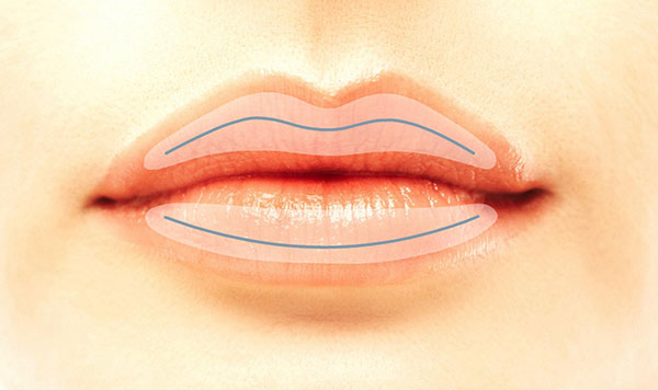  Volumenaufbau der Lippen mit Hyaluronsäure