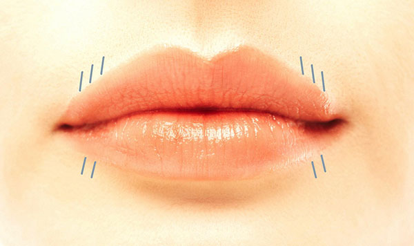 Aufspritzen der Lippenfalten (Raucherfalten) mit Hyaluronsäure