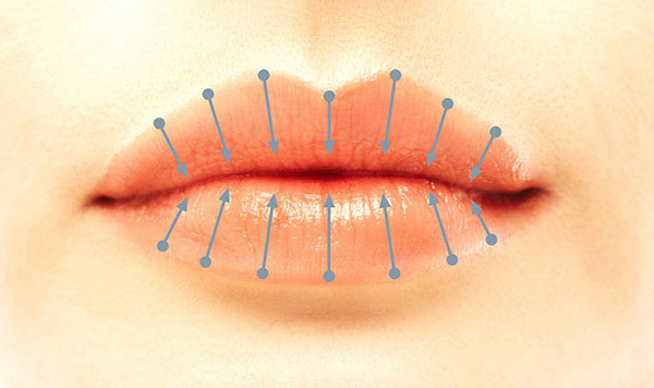 Lippenaufspritzen mit der senkrechten Technik