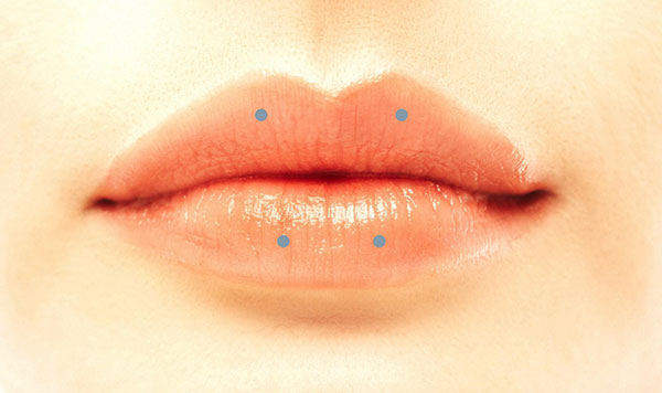 Punktuelles Aufspritzen der Lippen