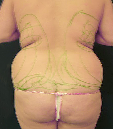 Markierungen für die Liposuction