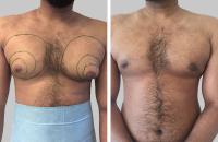 Gynäkomastie vor und nach einer Fettabsaugung und Brustdrüsenentfernung